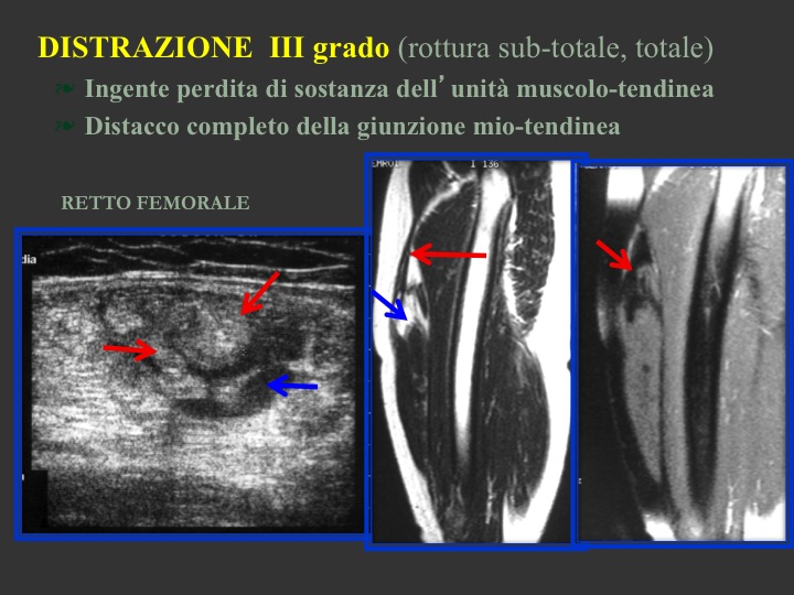Le lesioni muscolari | Radiologia Ortopedica